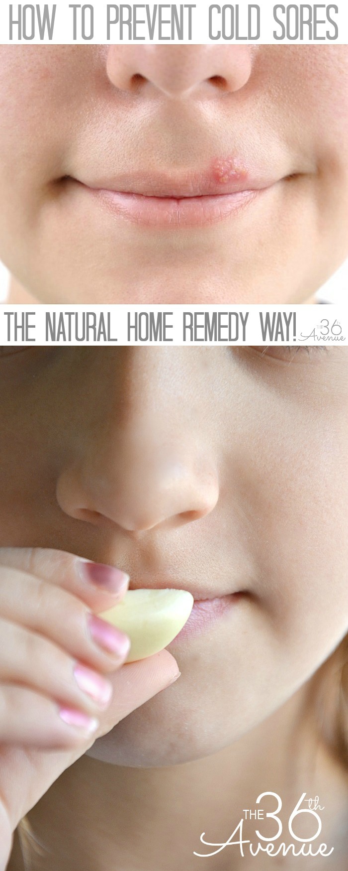 How to prevent COLD SORES at the36thavenue.com The easy NATURAL HOME REMEDY way.. You want to pin this! 